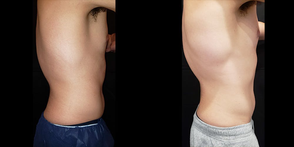 Coolsculpting Before & After Gallery - Patient 146866799 - Image 3