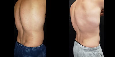 Coolsculpting Before & After Gallery - Patient 146866799 - Image 4