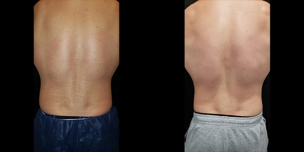Coolsculpting Before & After Gallery - Patient 146866799 - Image 5