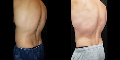 Coolsculpting Before & After Gallery - Patient 146866799 - Image 6