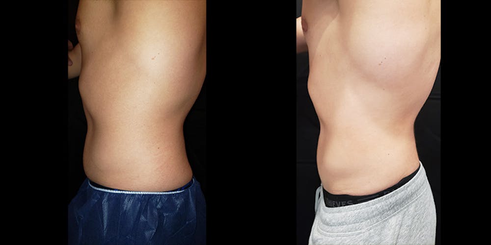 Coolsculpting Before & After Gallery - Patient 146866799 - Image 7
