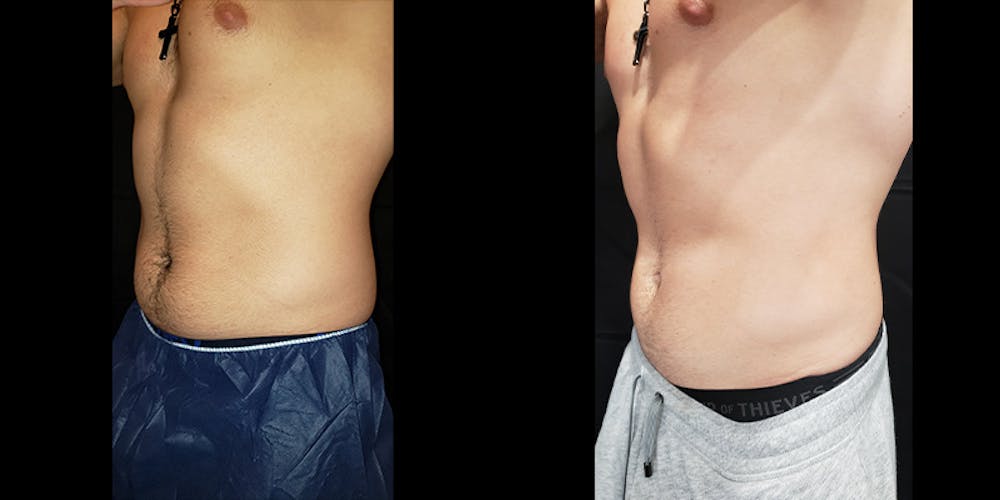 Coolsculpting Before & After Gallery - Patient 146866799 - Image 8