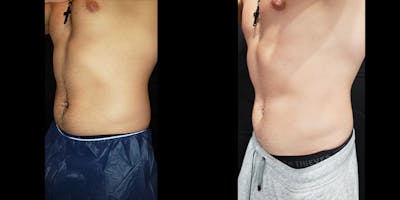 Coolsculpting Before & After Gallery - Patient 146866799 - Image 8