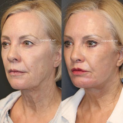 LoveLift - Lip Lift Before & After Gallery - Patient 146866868 - Image 2
