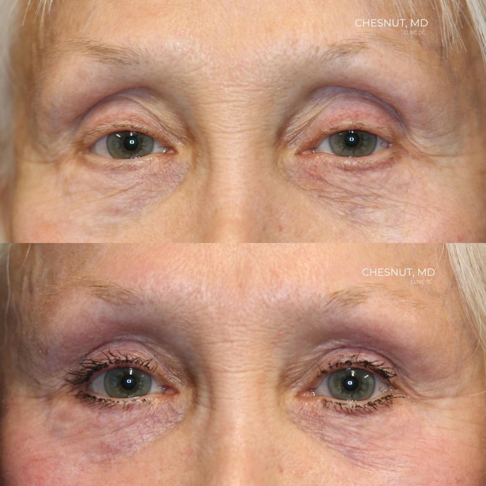  EnigmaLift - Upper Eyelid Surgery Before & After Gallery - Patient 146866905 - Image 1