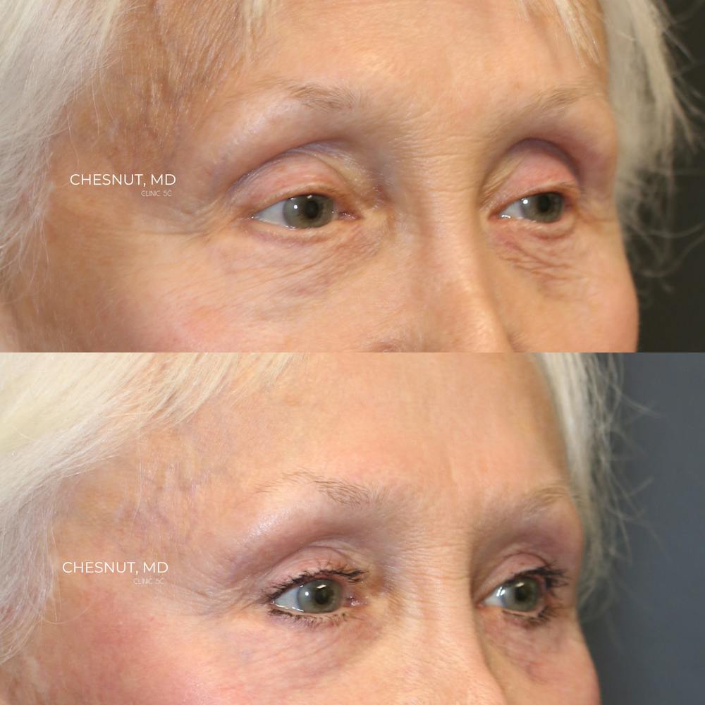  EnigmaLift - Upper Eyelid Surgery Before & After Gallery - Patient 146866905 - Image 2