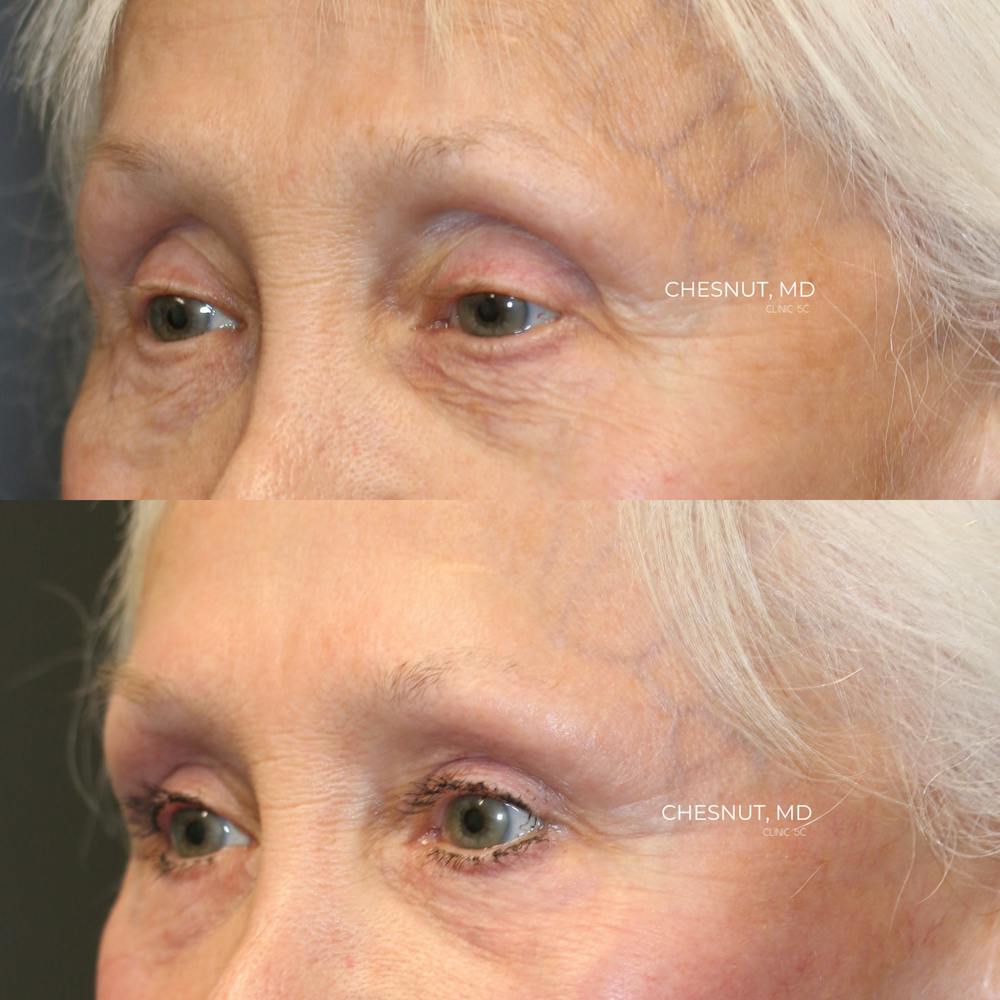 EnigmaLift - Brow Lift Before & After Gallery - Patient 146866908 - Image 3