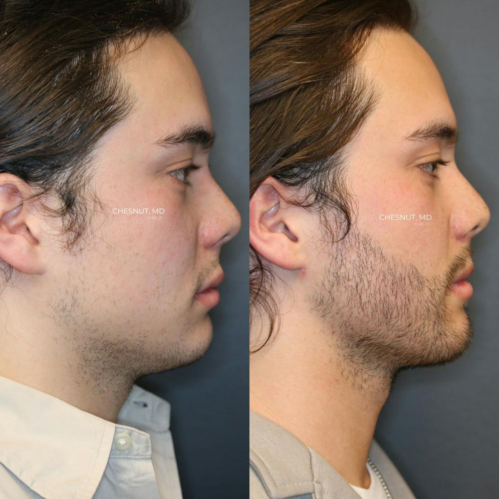 Hair Restoration Before & After Gallery - Patient 146866950 - Image 1