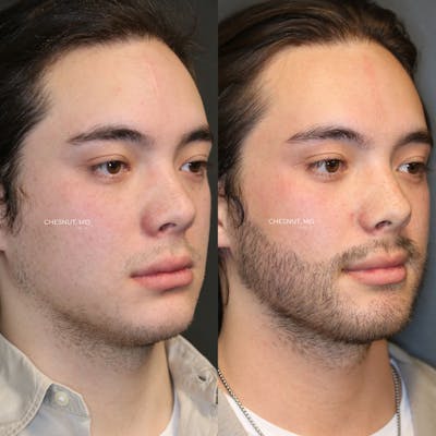 Hair Restoration Before & After Gallery - Patient 146866950 - Image 2