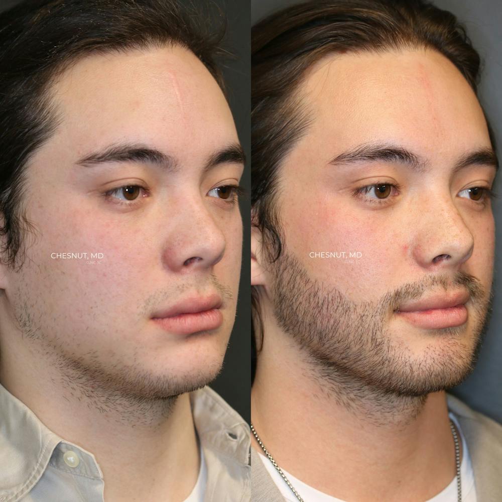 Hair Restoration Before & After Gallery - Patient 146866950 - Image 2