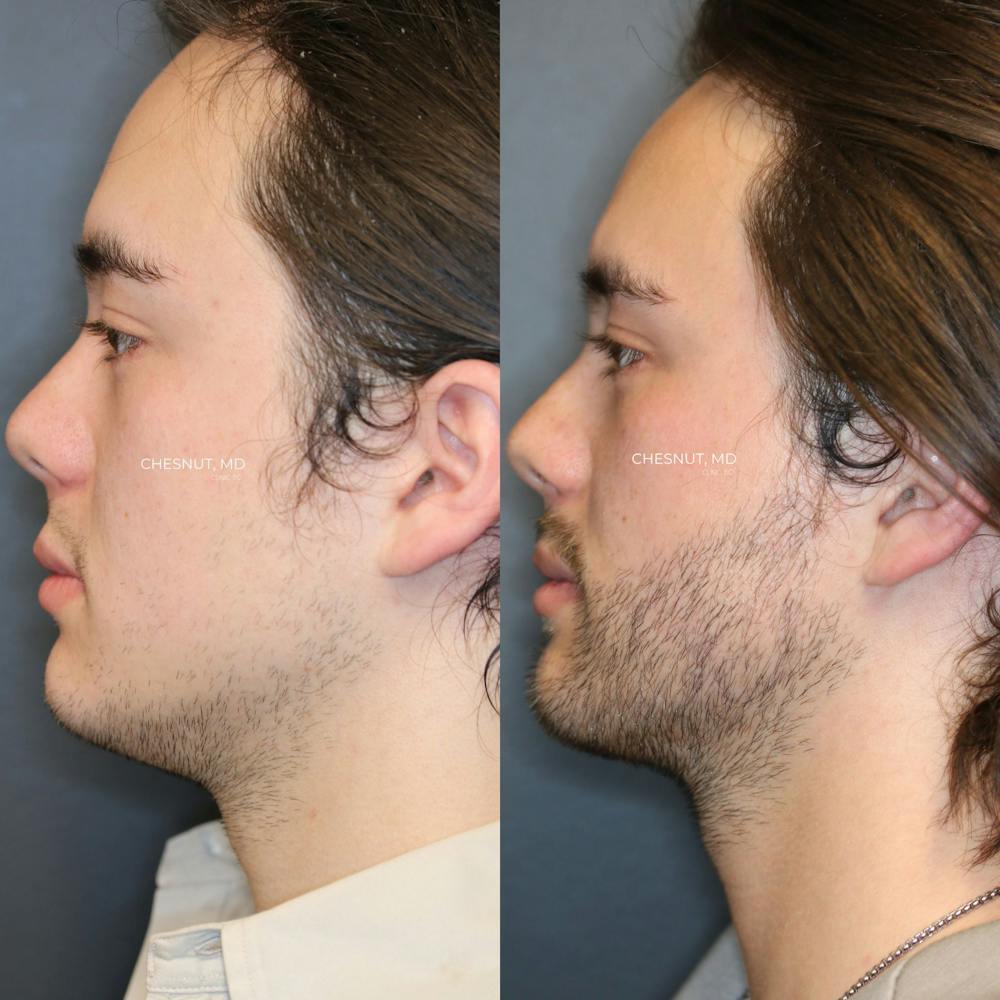 Hair Restoration Before & After Gallery - Patient 146866950 - Image 3