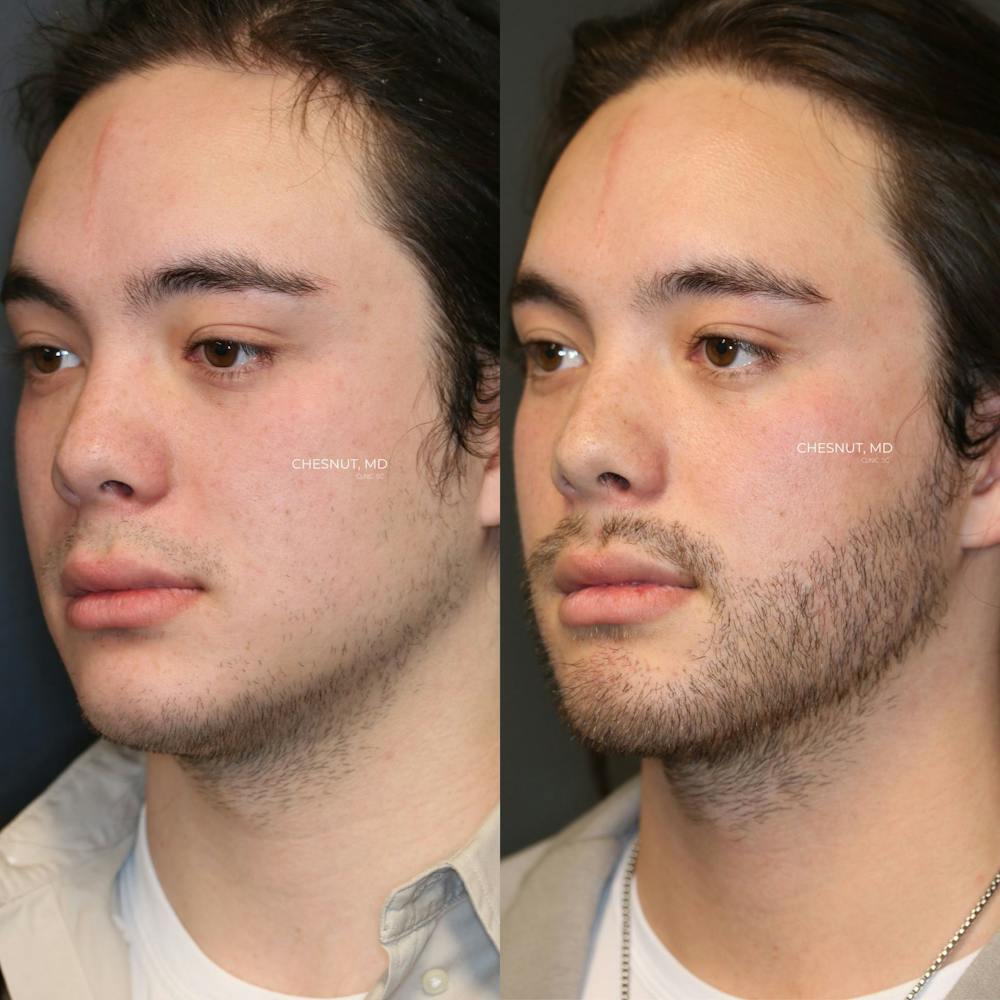 Hair Restoration Before & After Gallery - Patient 146866950 - Image 4