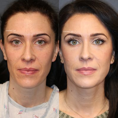 ÔPTIMized Facial Fat Transfer Before & After Gallery - Patient 146866960 - Image 1