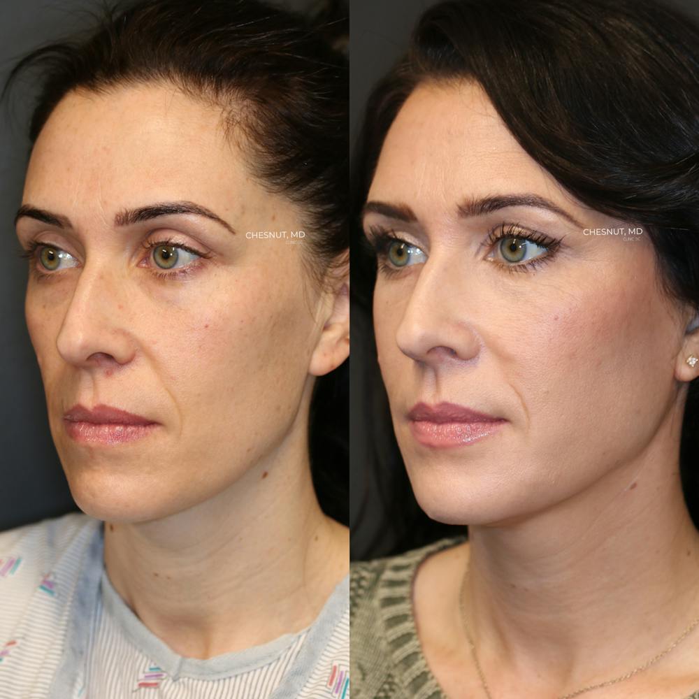 ÔPTIMized Facial Fat Transfer Before & After Gallery - Patient 146866960 - Image 2