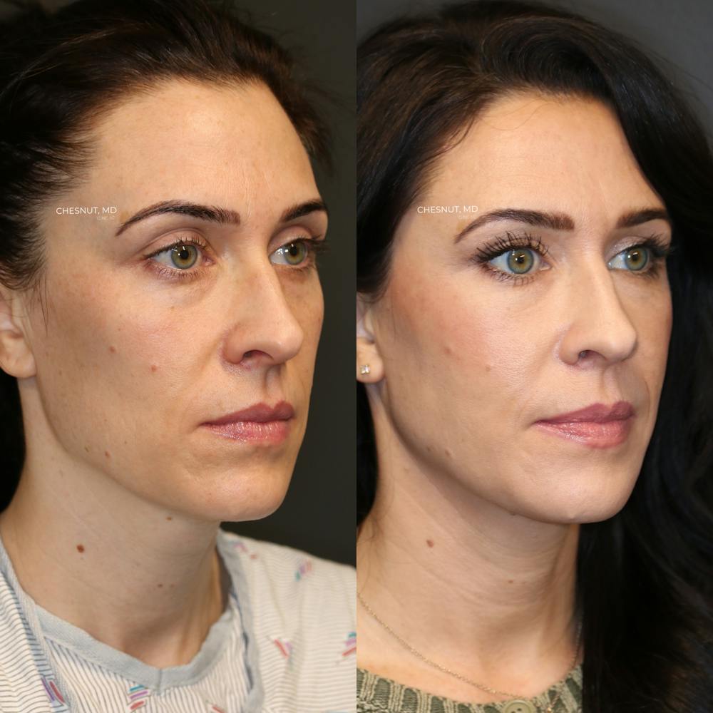 EnigmaLift - Eye Bag Removal Before & After Gallery - Patient 146866971 - Image 3