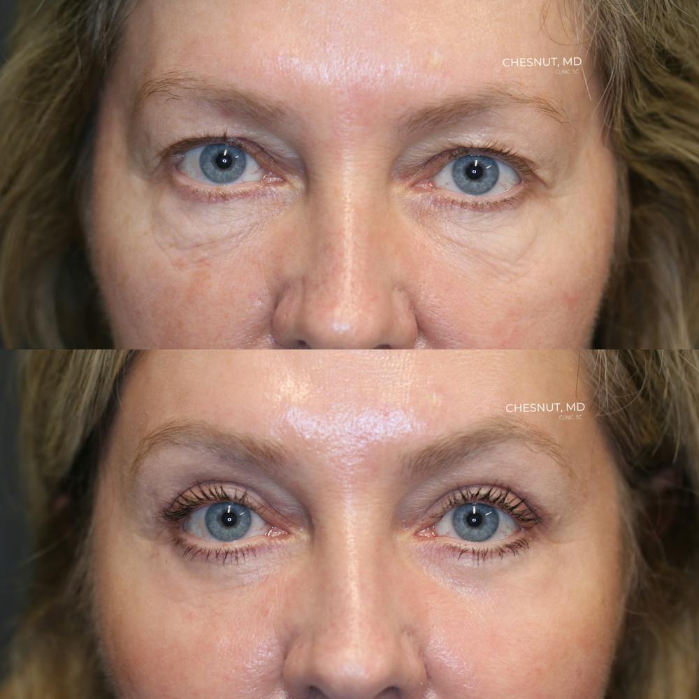 EnigmaLift - Mid Face Lift Before & After Gallery - Patient 146866990 - Image 1