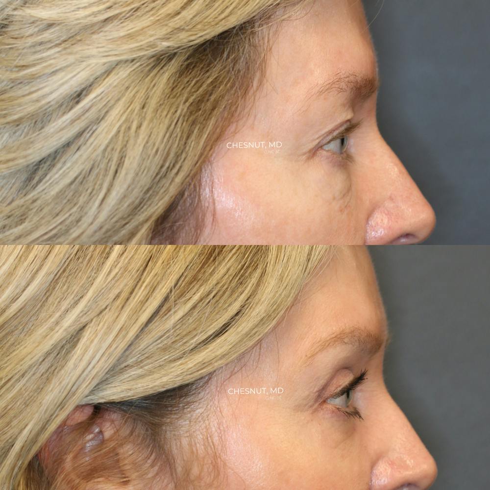 ÔPTIMized Laser Cocktail Before & After Gallery - Patient 146866993 - Image 2
