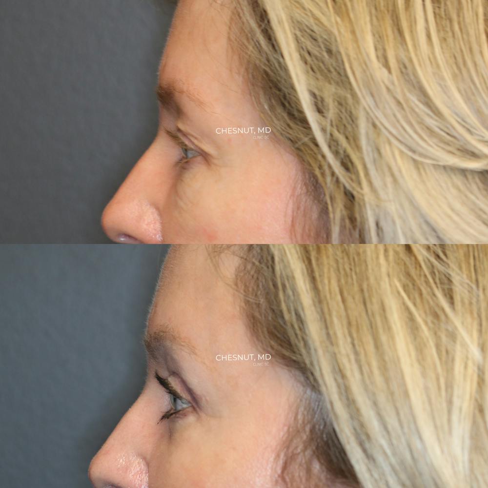 ÔPTIMized Laser Cocktail Before & After Gallery - Patient 146866993 - Image 3