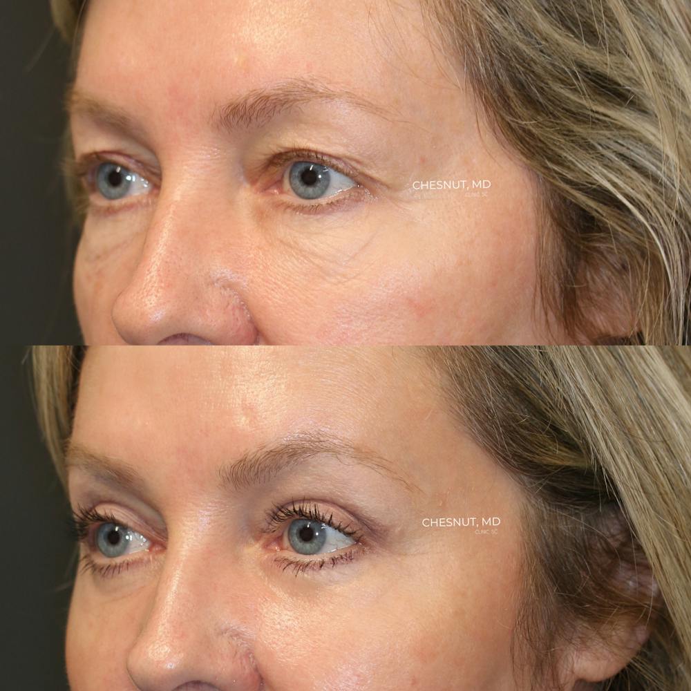 EnigmaLift - Brow Lift Before & After Gallery - Patient 146866988 - Image 4