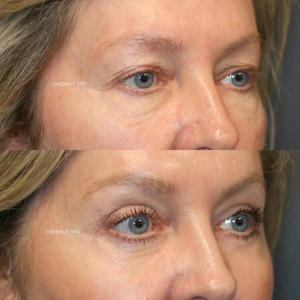 ÔPTIMized Laser Cocktail Before & After Gallery - Patient 146866993 - Image 5