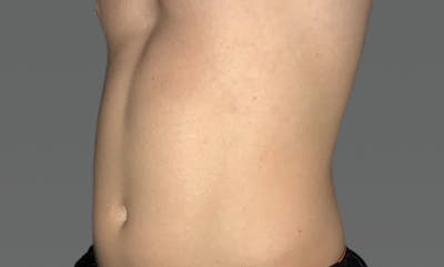 Coolsculpting Before & After Gallery - Patient 169753720 - Image 1