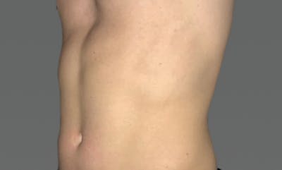 Coolsculpting Before & After Gallery - Patient 169753720 - Image 2