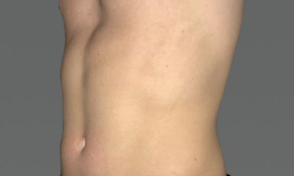 Coolsculpting Before & After Gallery - Patient 169753720 - Image 2