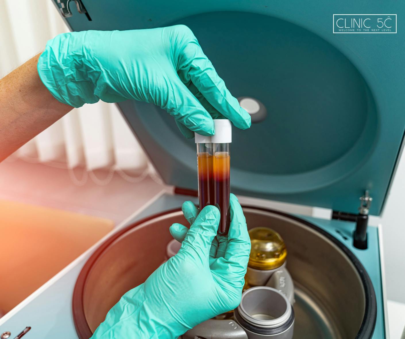 PRP vials being held in gloved hands