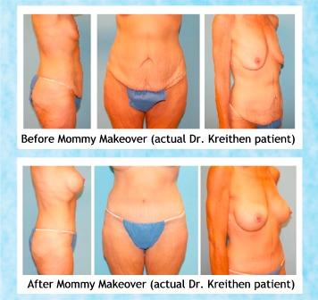 Holcomb - Kreithen Plastic Surgery & Medspa Blog | Body Contouring Helps Post-Bariatric Surgery Patients Keep off the Weight