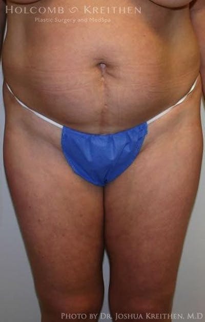 Tummy Tuck Before & After Gallery - Patient 6236435 - Image 1