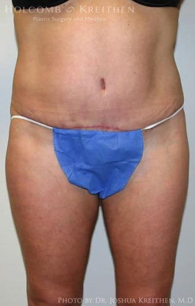 Tummy Tuck Before & After Gallery - Patient 6236435 - Image 2