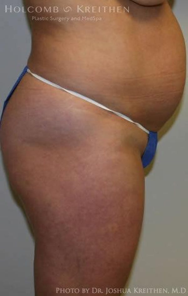 Tummy Tuck Before & After Gallery - Patient 6236435 - Image 3