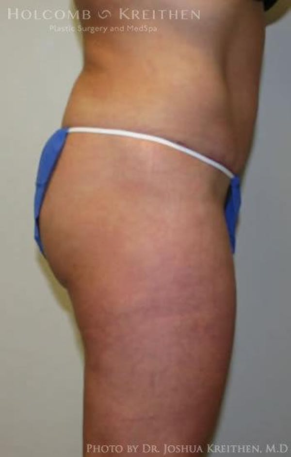 Tummy Tuck Before & After Gallery - Patient 6236435 - Image 4
