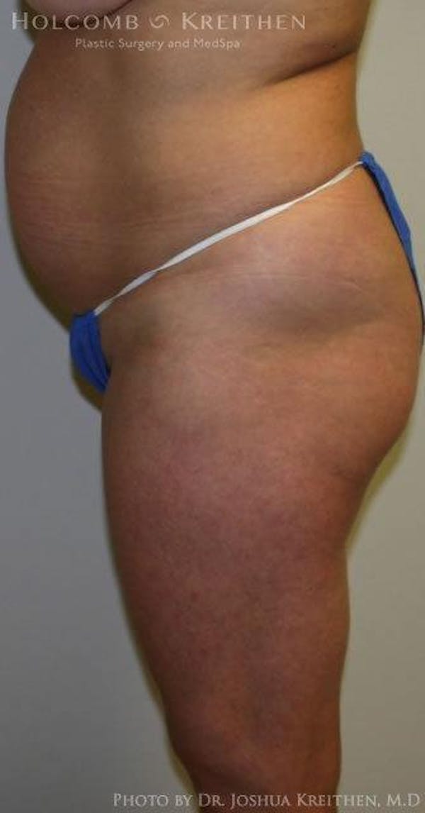 Tummy Tuck Before & After Gallery - Patient 6236435 - Image 5