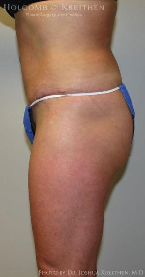 Tummy Tuck Gallery - Patient 6236435 - Image 6