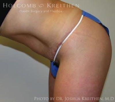 Tummy Tuck Before & After Gallery - Patient 6236435 - Image 8