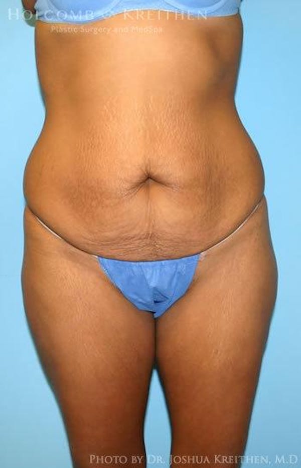 Tummy Tuck Before & After Gallery - Patient 6236437 - Image 1