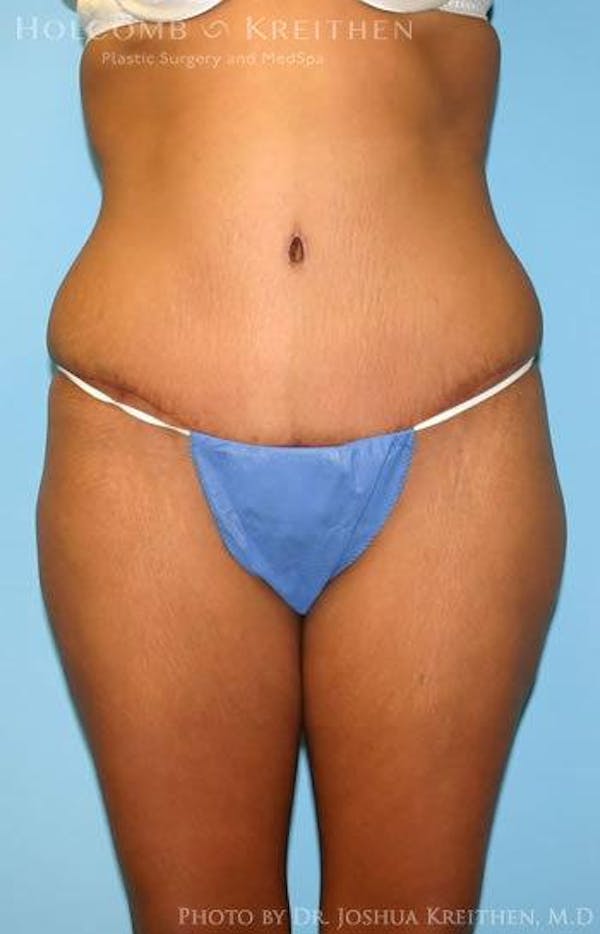 Tummy Tuck Before & After Gallery - Patient 6236437 - Image 2