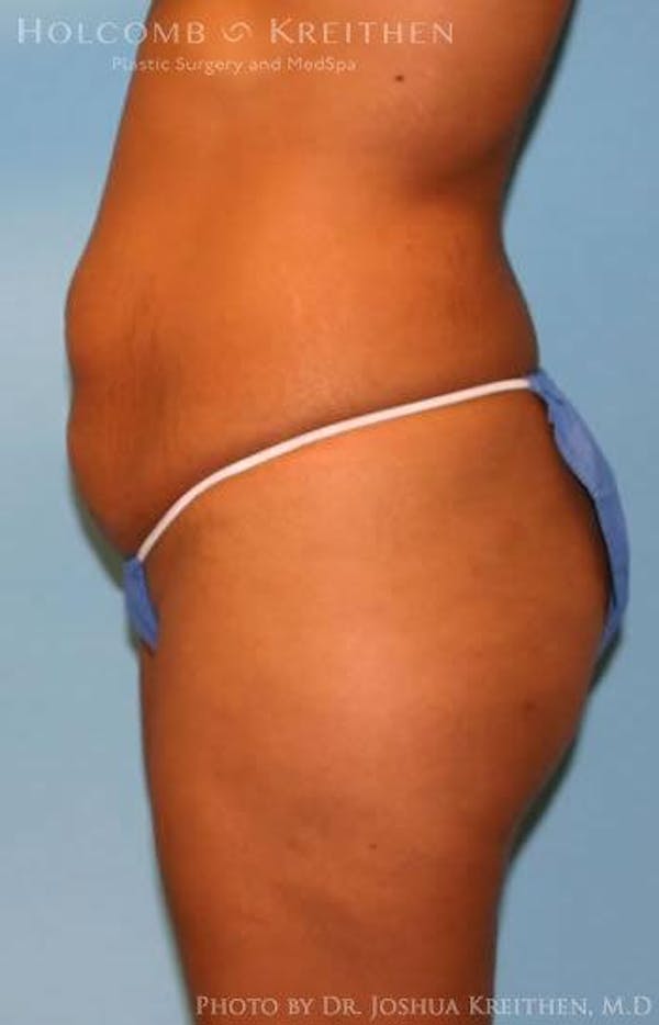 Tummy Tuck Before & After Gallery - Patient 6236437 - Image 3