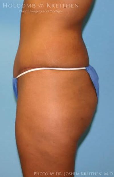 Tummy Tuck Gallery - Patient 6236437 - Image 4