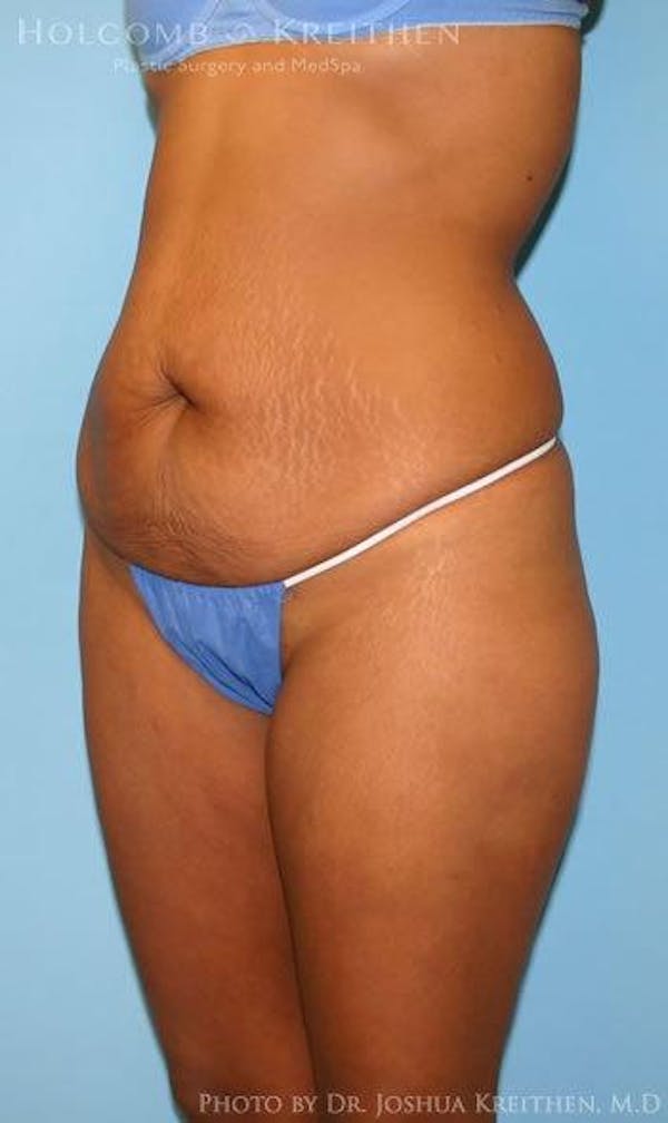 Tummy Tuck Before & After Gallery - Patient 6236437 - Image 5