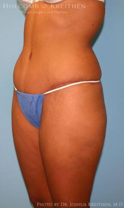 Tummy Tuck Before & After Gallery - Patient 6236437 - Image 6