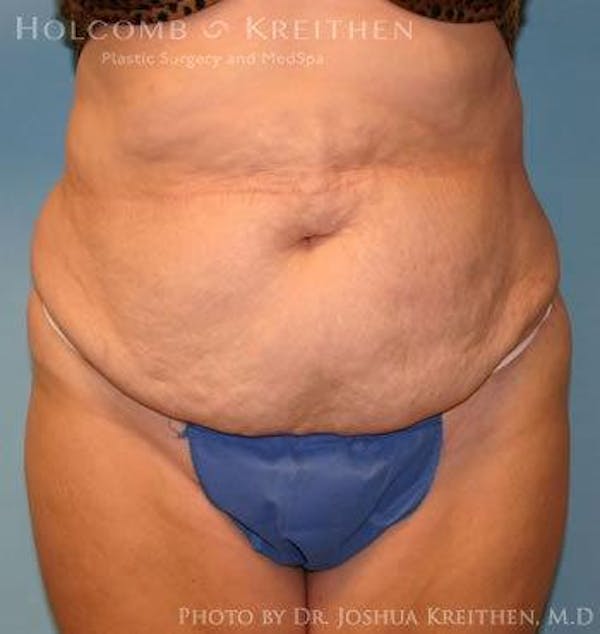 Tummy Tuck Before & After Gallery - Patient 6236440 - Image 1