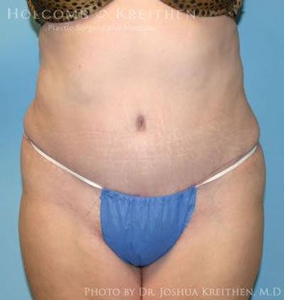 Tummy Tuck Before & After Gallery - Patient 6236440 - Image 2