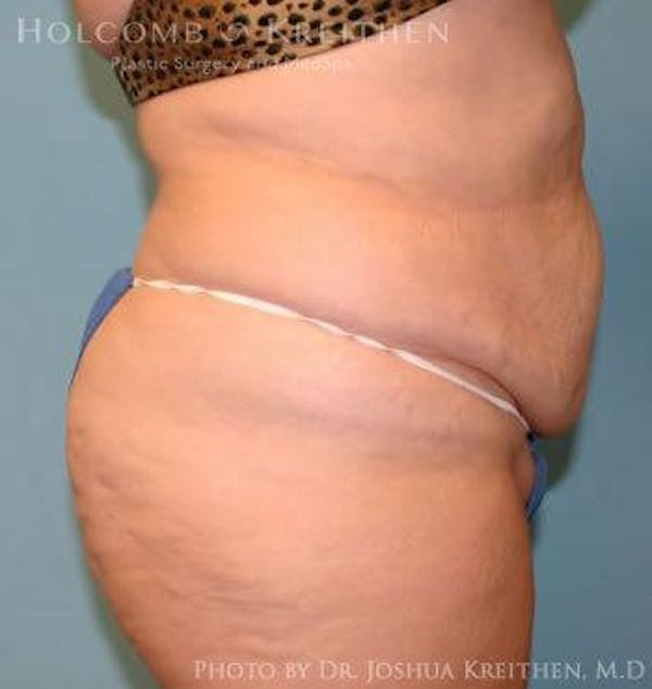 Tummy Tuck Before & After Gallery - Patient 6236440 - Image 3