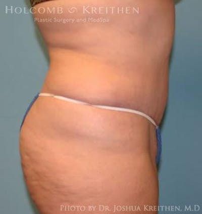 Tummy Tuck Before & After Gallery - Patient 6236440 - Image 4