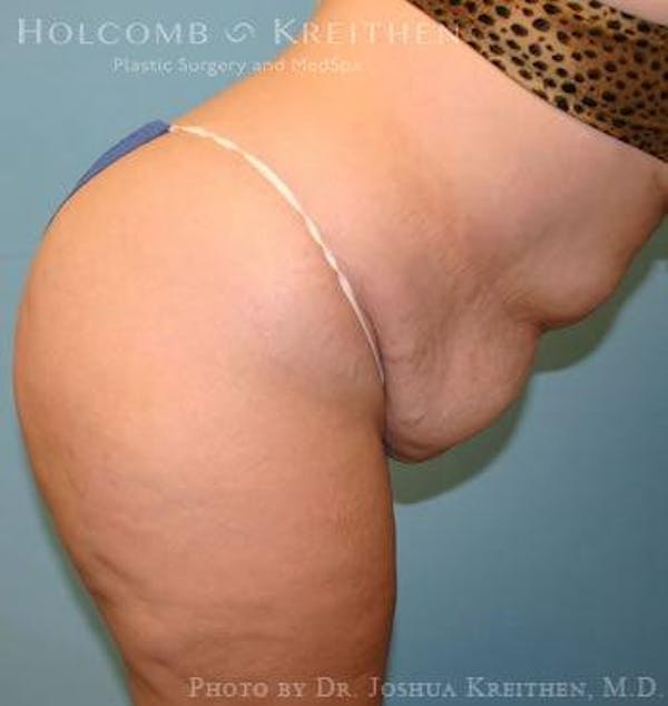 Tummy Tuck Before & After Gallery - Patient 6236440 - Image 5