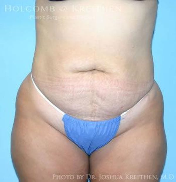Tummy Tuck Before & After Gallery - Patient 6236445 - Image 1