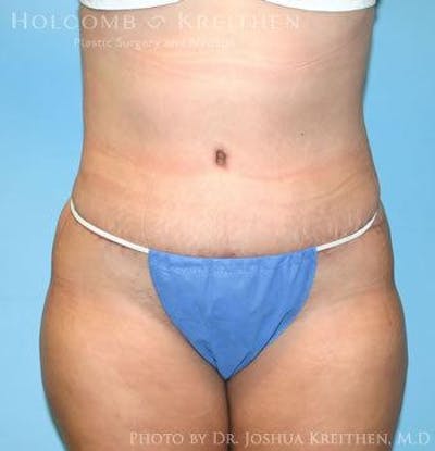 Tummy Tuck Before & After Gallery - Patient 6236445 - Image 2