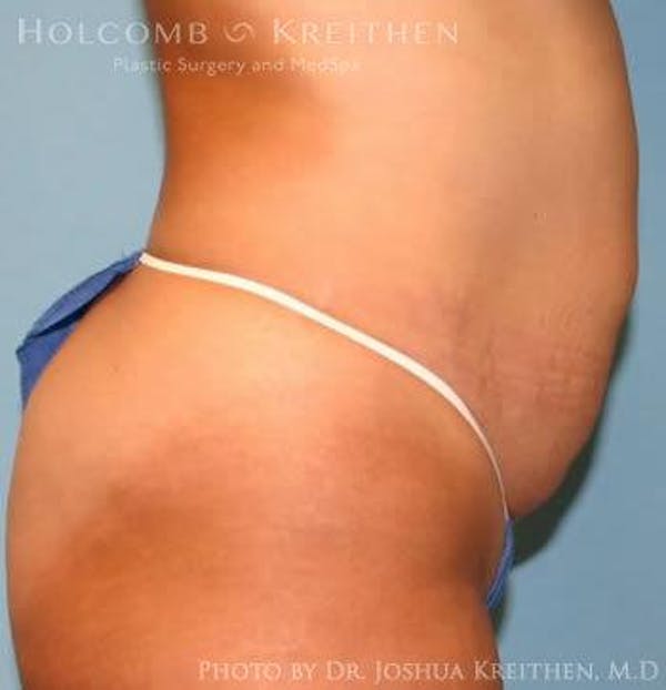 Tummy Tuck Before & After Gallery - Patient 6236445 - Image 3